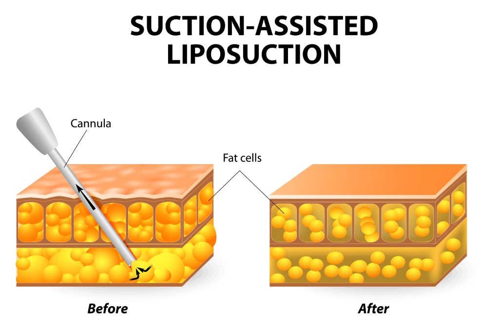 lipo 360 | liposuction surgery