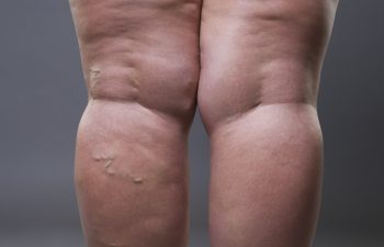 lipedema and cellulite