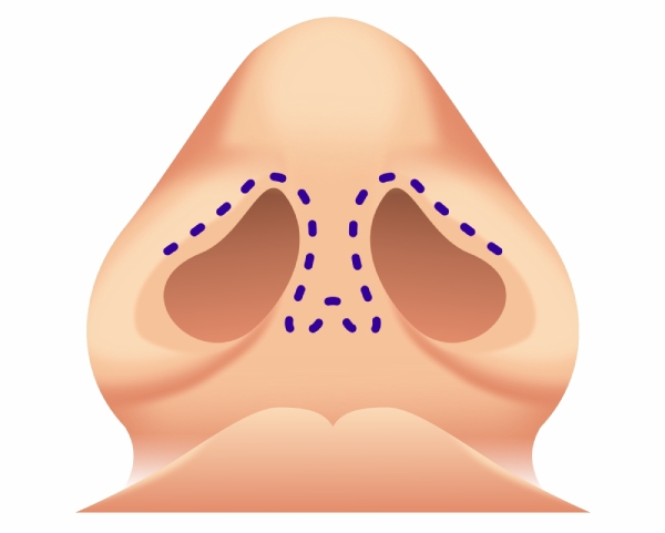 Procedimiento de rinoplastia abierta