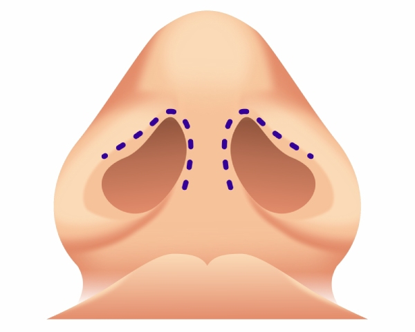 Procedimiento de rinoplastia cerrada