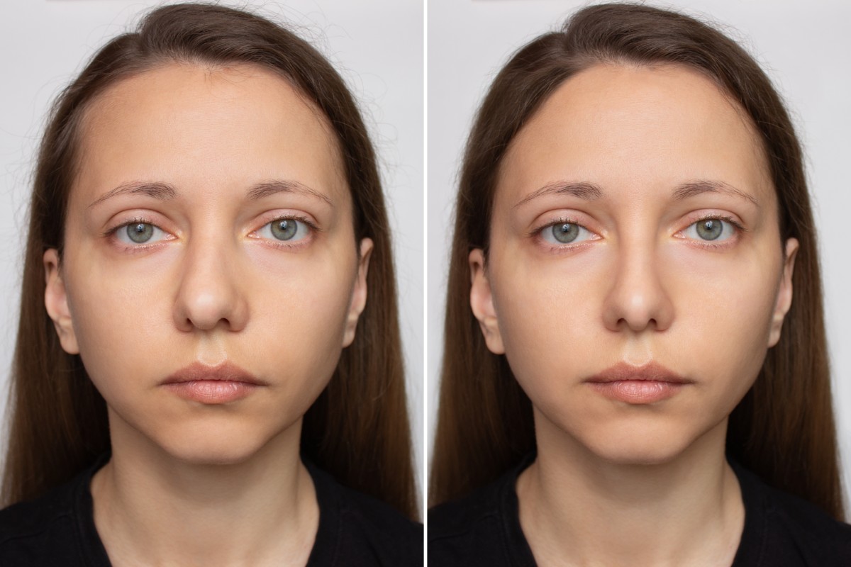 Antes y después de una rinoplastia