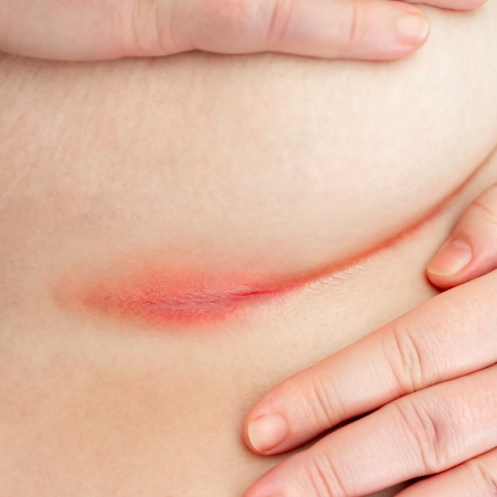 skin irritation under breast, with redness