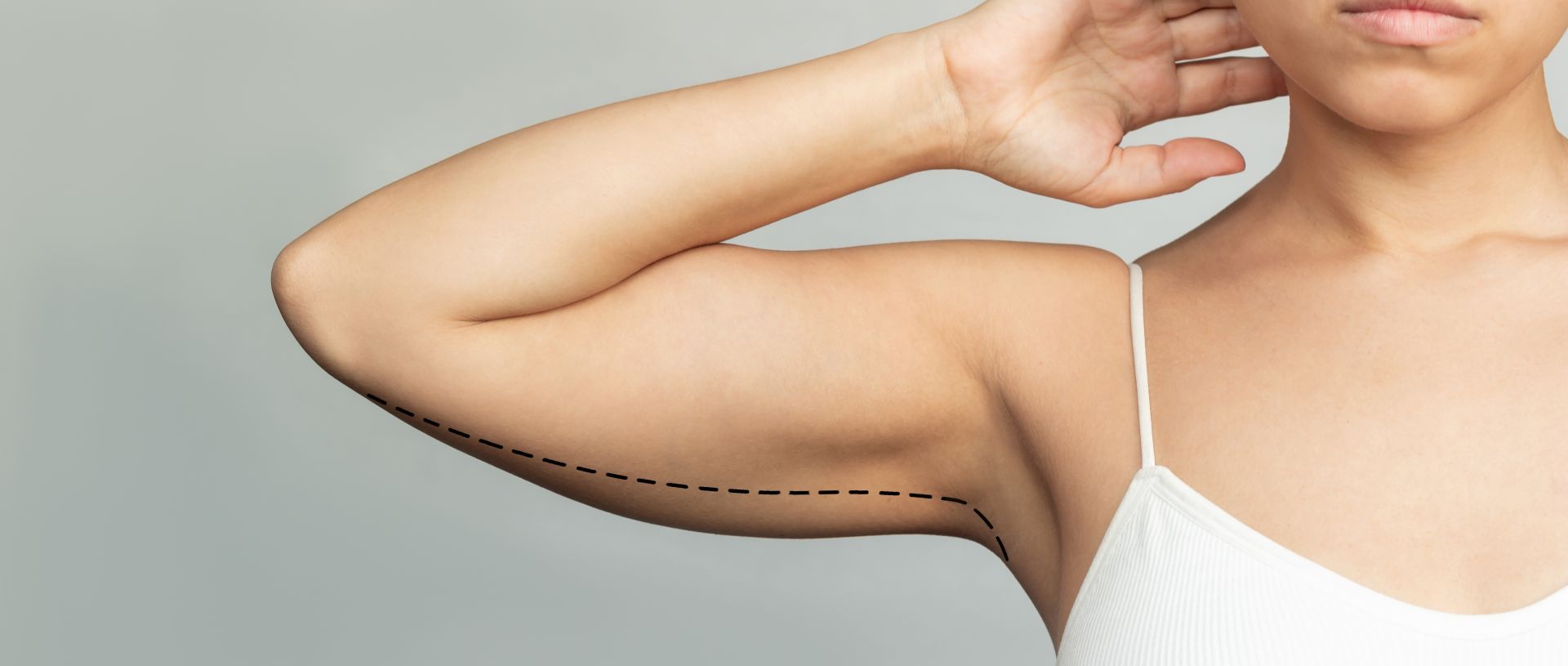 Forearm and Upper Arm Lift