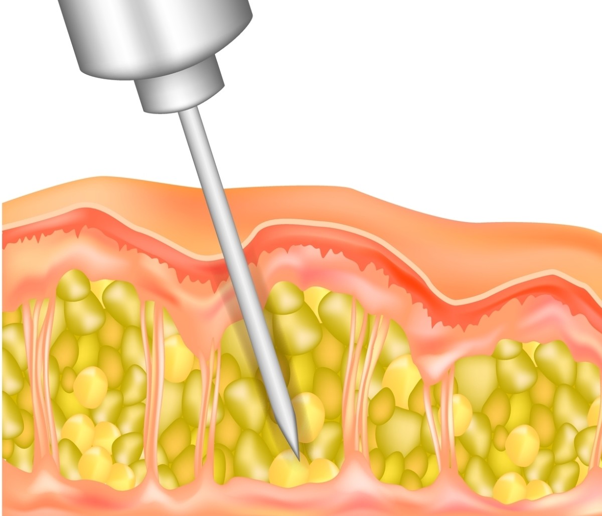 liposucción para hendiduras en las caderas, antes