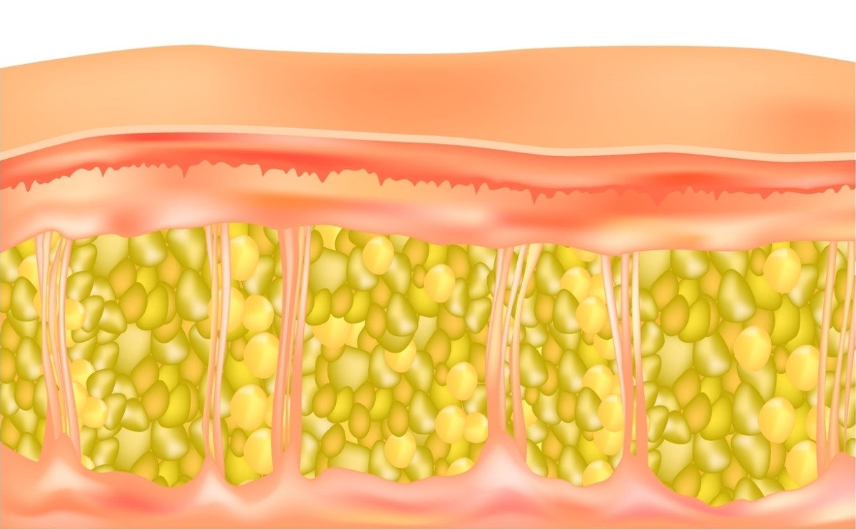 liposucción para hendiduras en las caderas, después