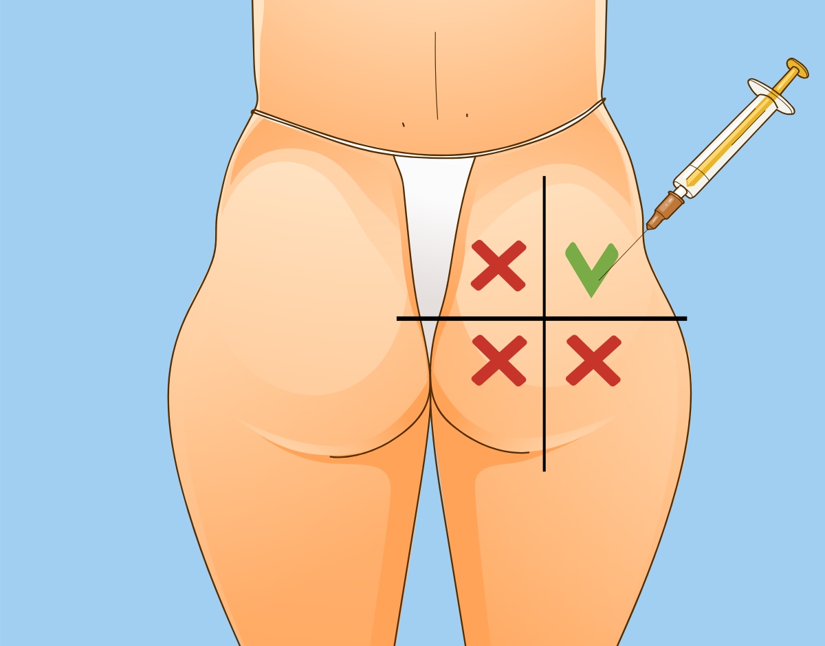hip dip filler injections