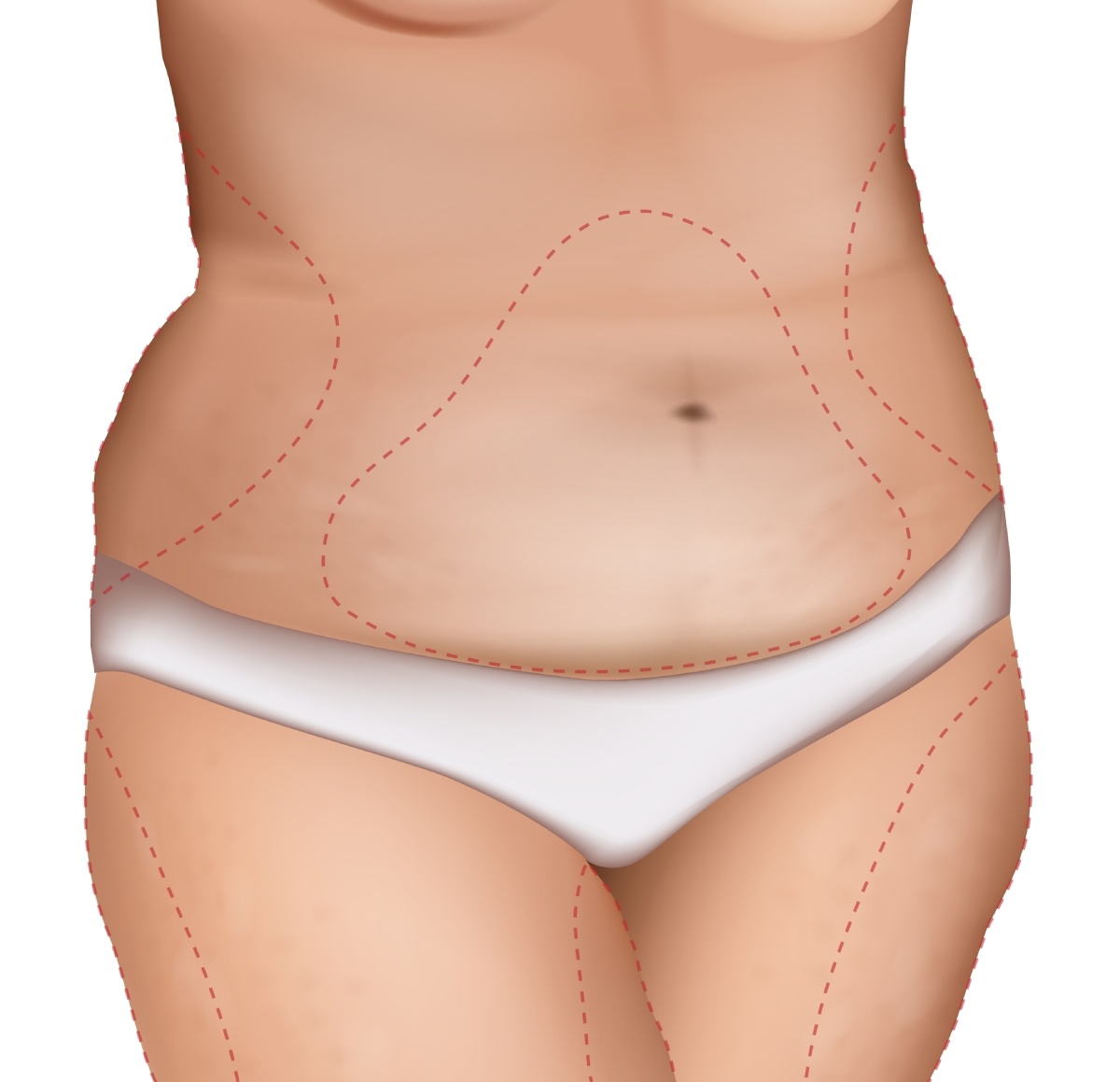 liposucción para hendiduras en las caderas