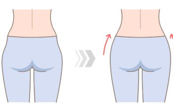 hip dips before and after