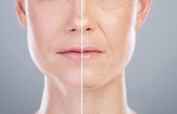 facelift before and after