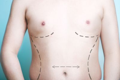 a man before daddy do-over cosmetic surgety with surgical marking on his chest and abdomen