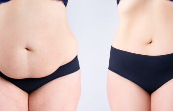 Tummy tuck before and after