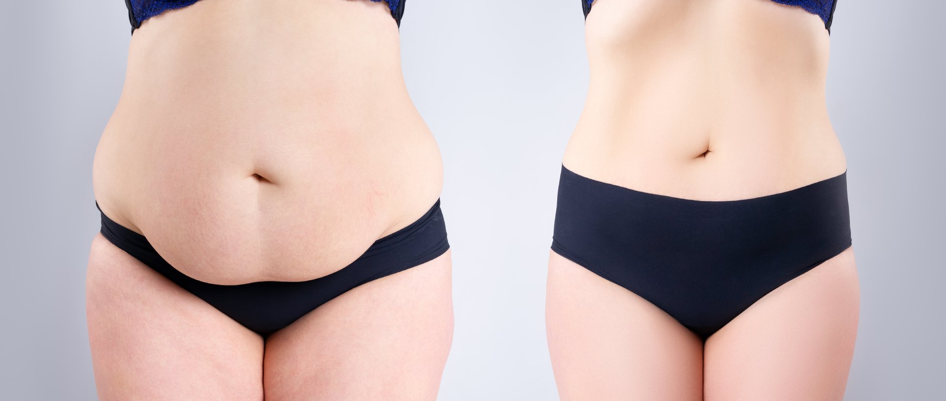 Tummy tuck before and after