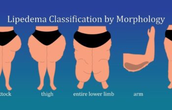 Lipedema Classification by Morphology: buttock, tight, entire lower limb, arm and leg | lower body and arm cuffing with lipedema