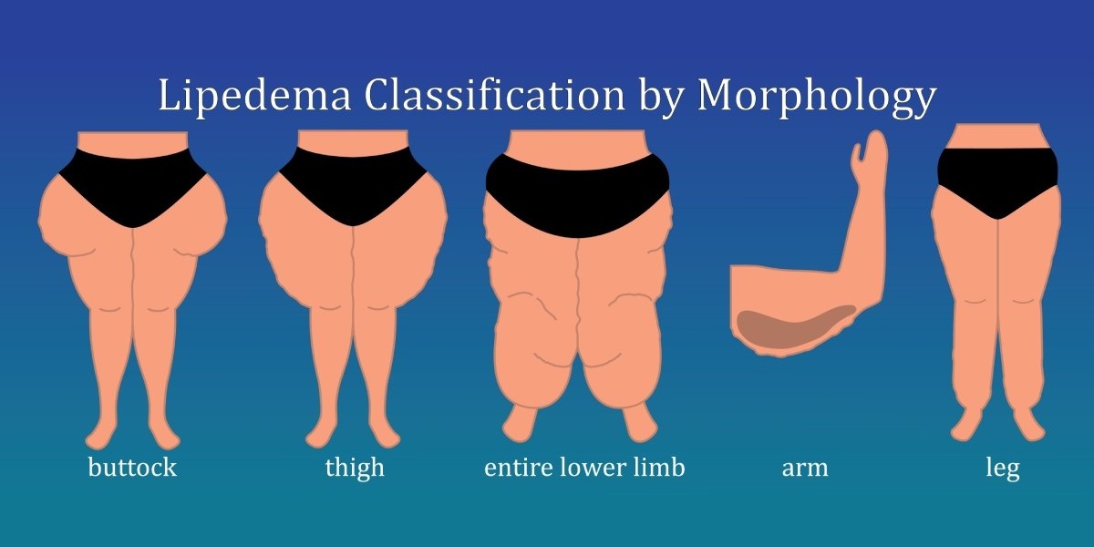 Lipedema Classification by Morphology: buttock, tight, entire lower limb, arm and leg | lower body and arm cuffing with lipedema