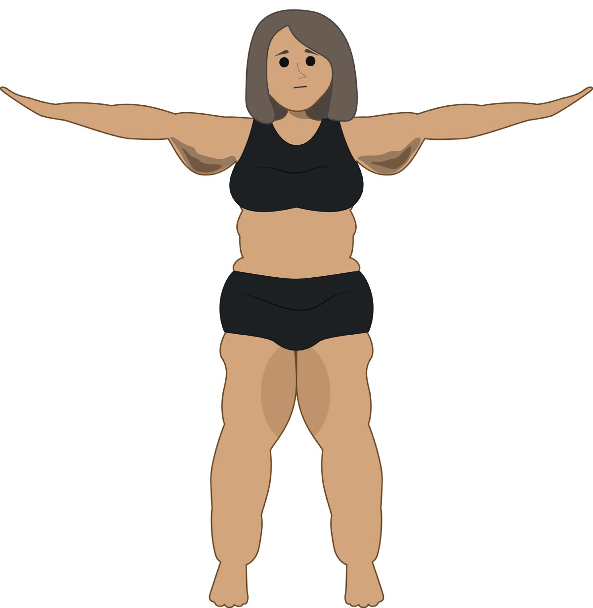 abnormal fat distribution with lipedema