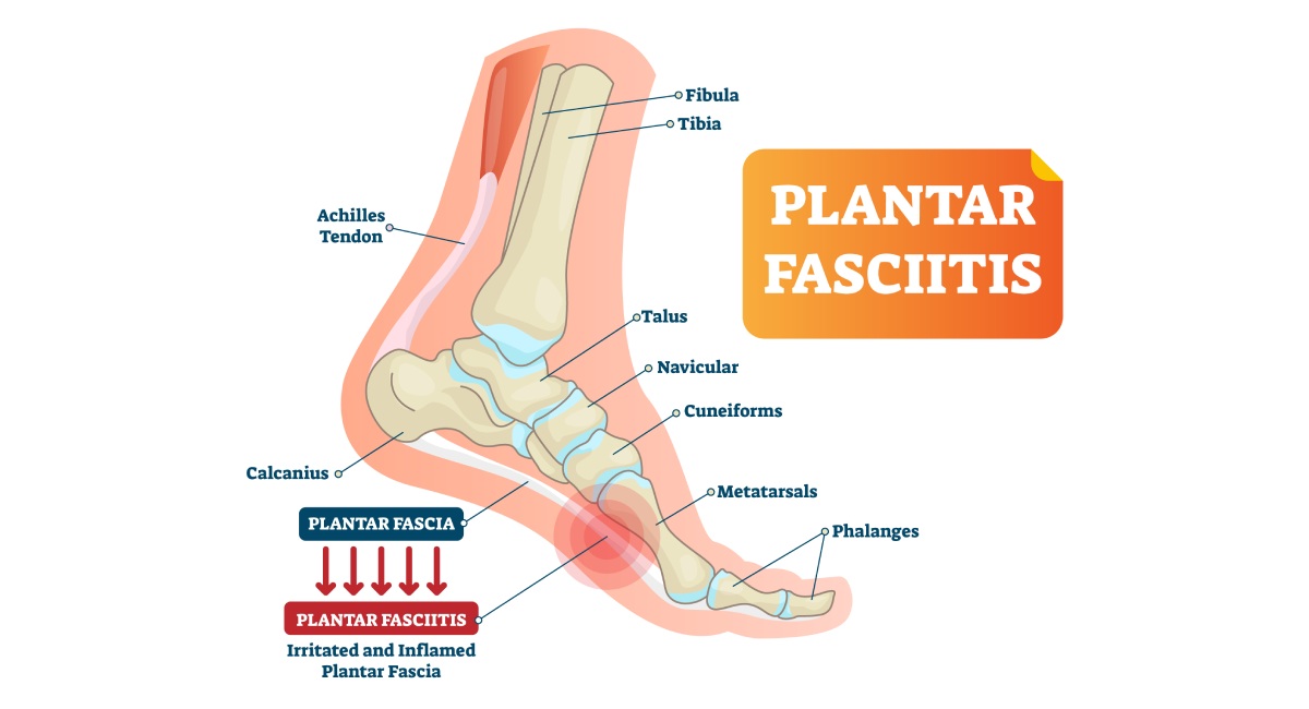 Anatomical diagram of the foot showing plantar fasciitis. Bones labeled on the right: Fibula, Tibia, Talus, Navicular, Cuneiforms, Metatarsals, Phalanges. Structures on the left: Achilles Tendon, Calcaneus. Irritated and inflamed plantar fascia highlighted at the level of the metatarsals.