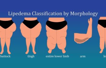 Lipedema Classification by Morphology: buttock, tight, entire lower limb, arm and leg | lower body and arm cuffing with lipedema