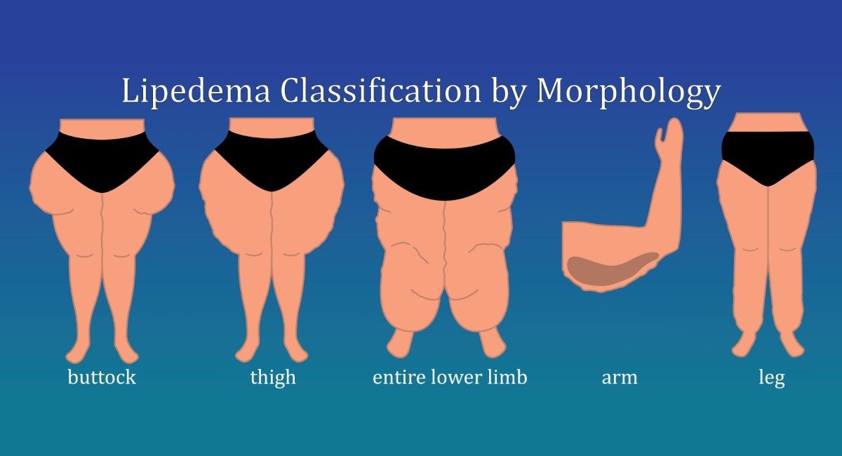 Lipedema Classification by Morphology: buttock, tight, entire lower limb, arm and leg | lower body and arm cuffing with lipedema