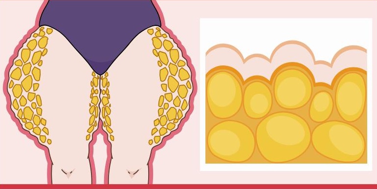 grasa con lipedema