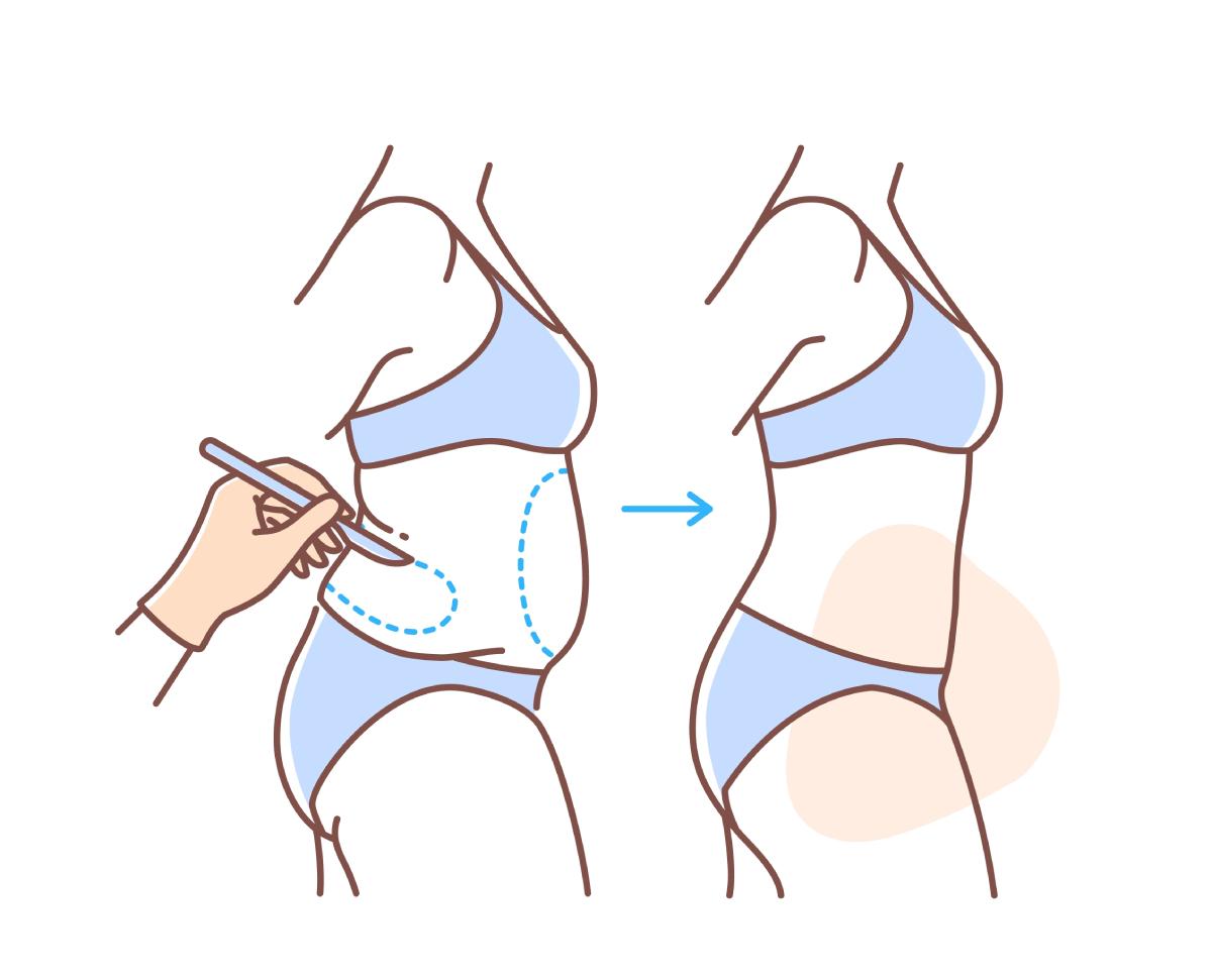 Illustration of a woman with highlighted problem areas related to lipedema, showing body contour and treatment concept.