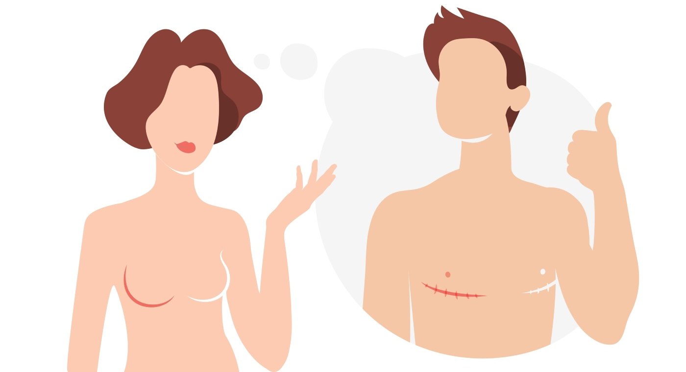Ilustración que muestra los resultados de la cirugía de masculinización torácica FTM, antes y después de la cirugía de pecho