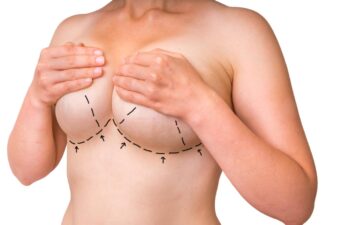 breast lift