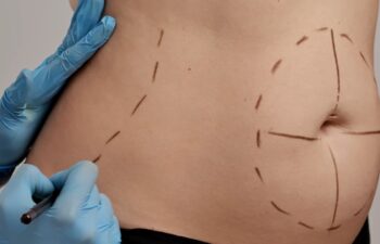 A lipo 360 patient and a plastic surgeon making pre-surgical marking