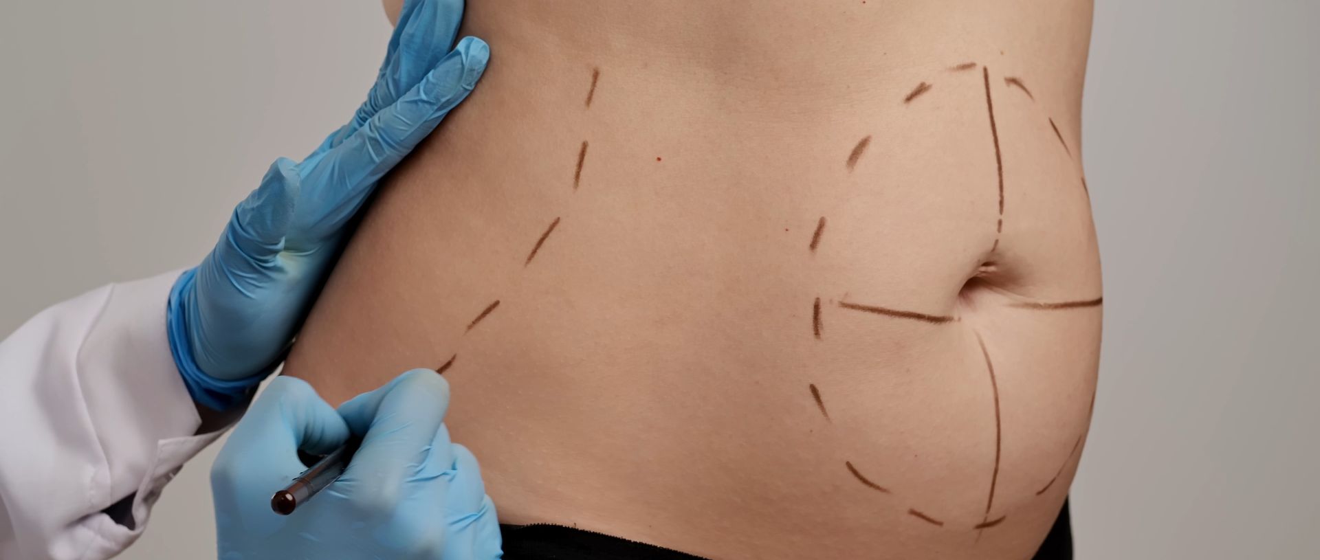 A lipo 360 patient and a plastic surgeon making pre-surgical marking