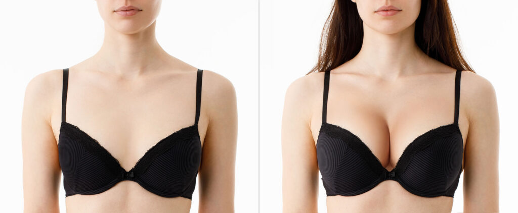 A before-and-after comparison of a woman's chest area. On the left, she is shown with a smaller bust wearing a black bra. On the right, the same woman is shown with a noticeably fuller and more enhanced bust in the same black bra.