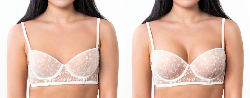A side-by-side comparison of a female torso in a white lace bra. The left image shows a smaller breast size, while the right image demonstrates an increased volume and uplifted appearance, typical of a breast augmentation or push-up effect.