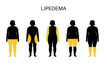 Five female silhouettes highlighting different body areas (legs, arms, hips) where Lipedema fat accumulates.