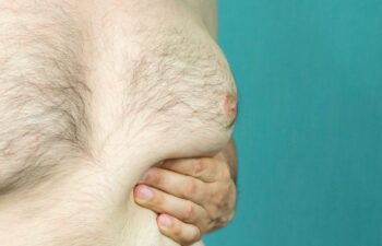 Man with gynecomastia touching his enlarged breast
