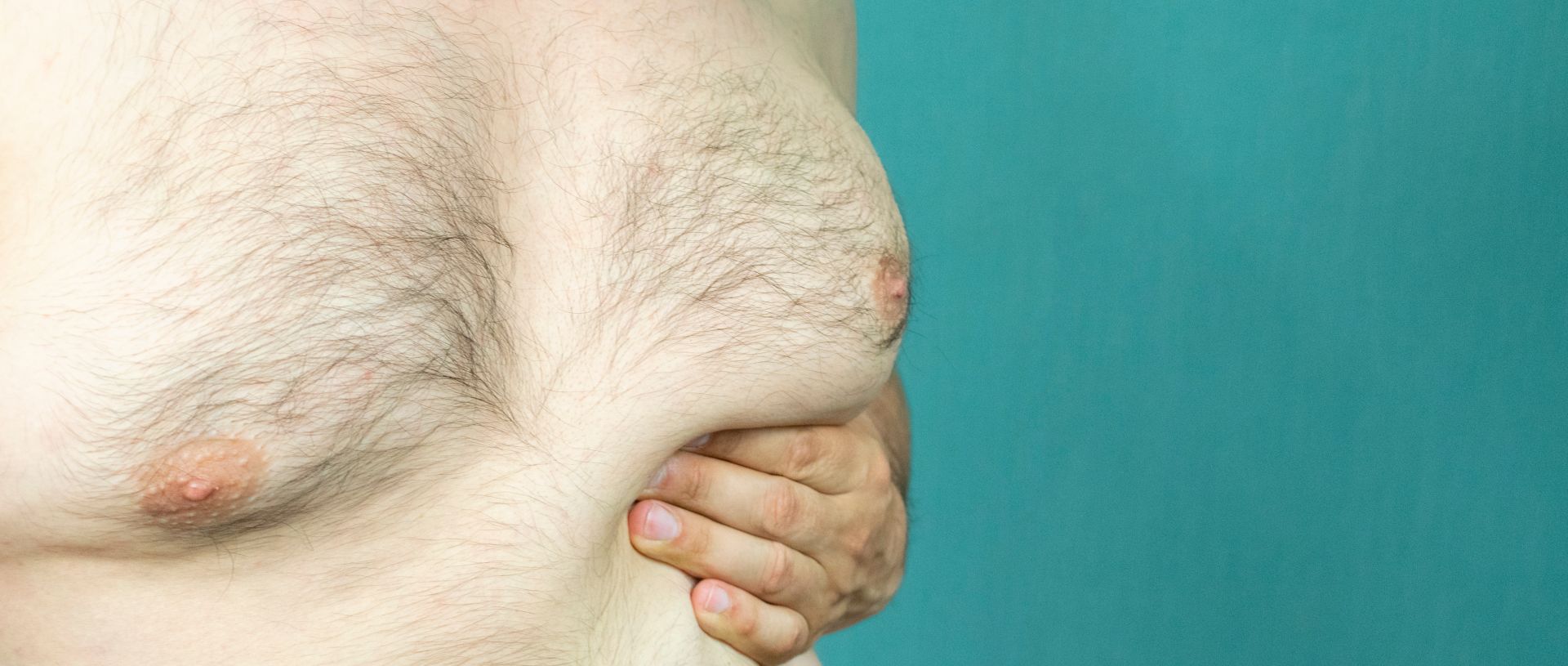 Man with gynecomastia touching his enlarged breast