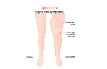 Illustration comparing normal legs with legs affected by lipedema, showing enlarged lower body, orange peel skin texture, and disproportionate fat accumulation in the legs.