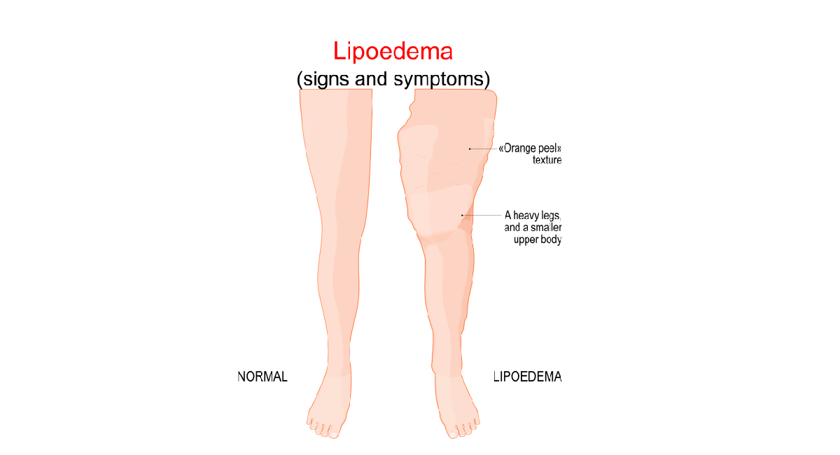 Illustration comparing normal legs with legs affected by lipedema, showing enlarged lower body, orange peel skin texture, and disproportionate fat accumulation in the legs.