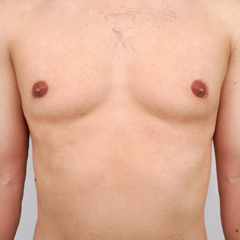 Male patient's chest after gynecomastia surgery