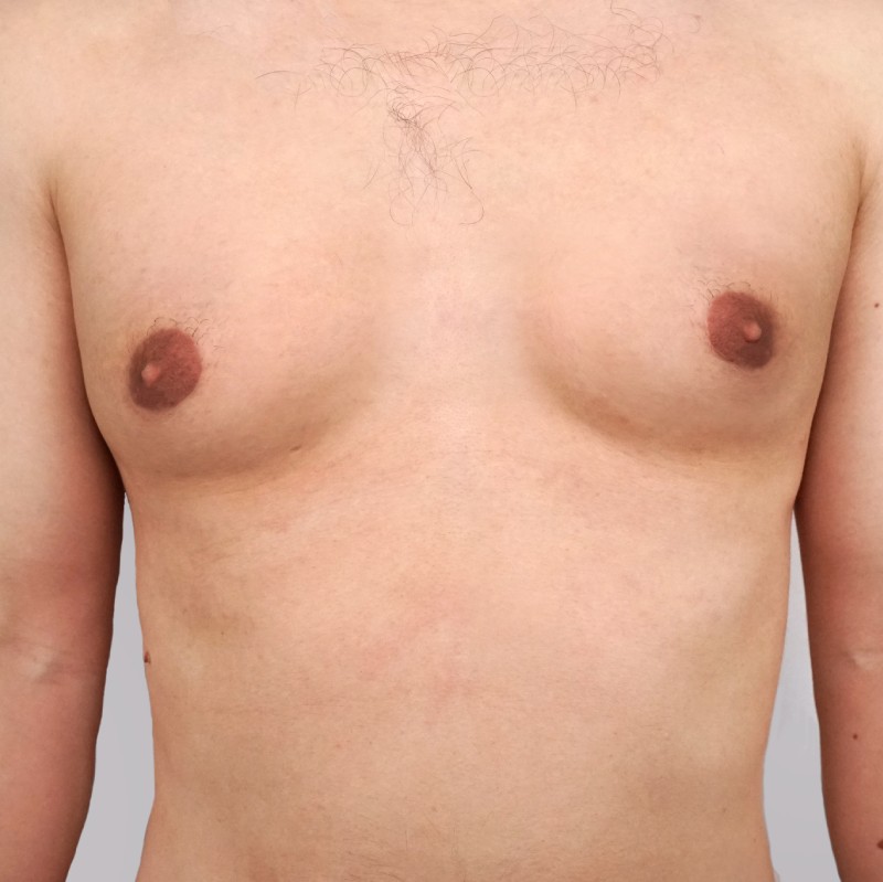 A close-up view of a person's bare chest, showing visible breast tissue and nipples against a neutral background.