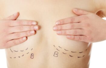 Person covering chest with hands, with surgical markings and the letter "B" drawn under each breast, suggesting preparation for breast surgery or augmentation.