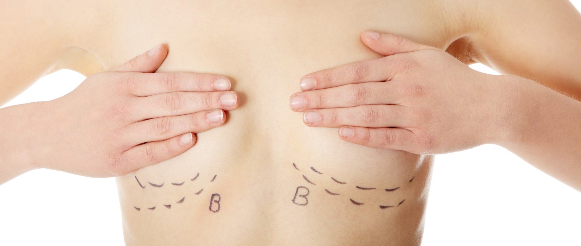 Person covering chest with hands, with surgical markings and the letter 