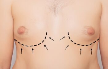 Bare chest of a person with dashed and solid black lines and arrows drawn, indicating markings for a surgical procedure.