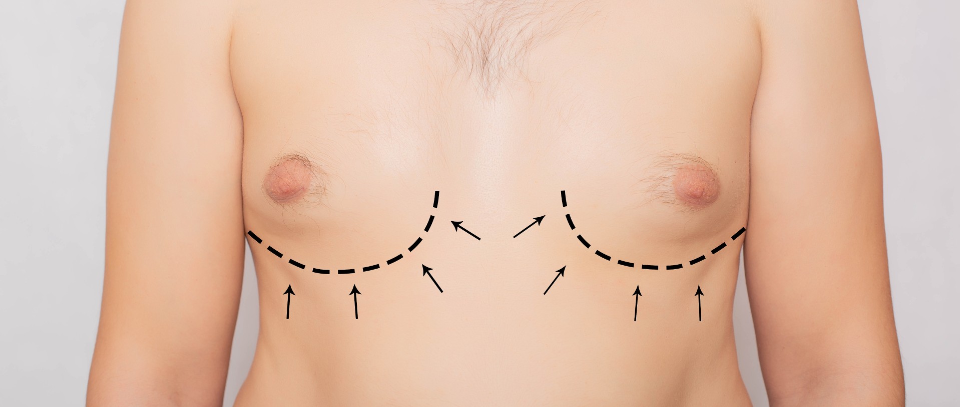 Bare chest of a person with dashed and solid black lines and arrows drawn, indicating markings for a surgical procedure.