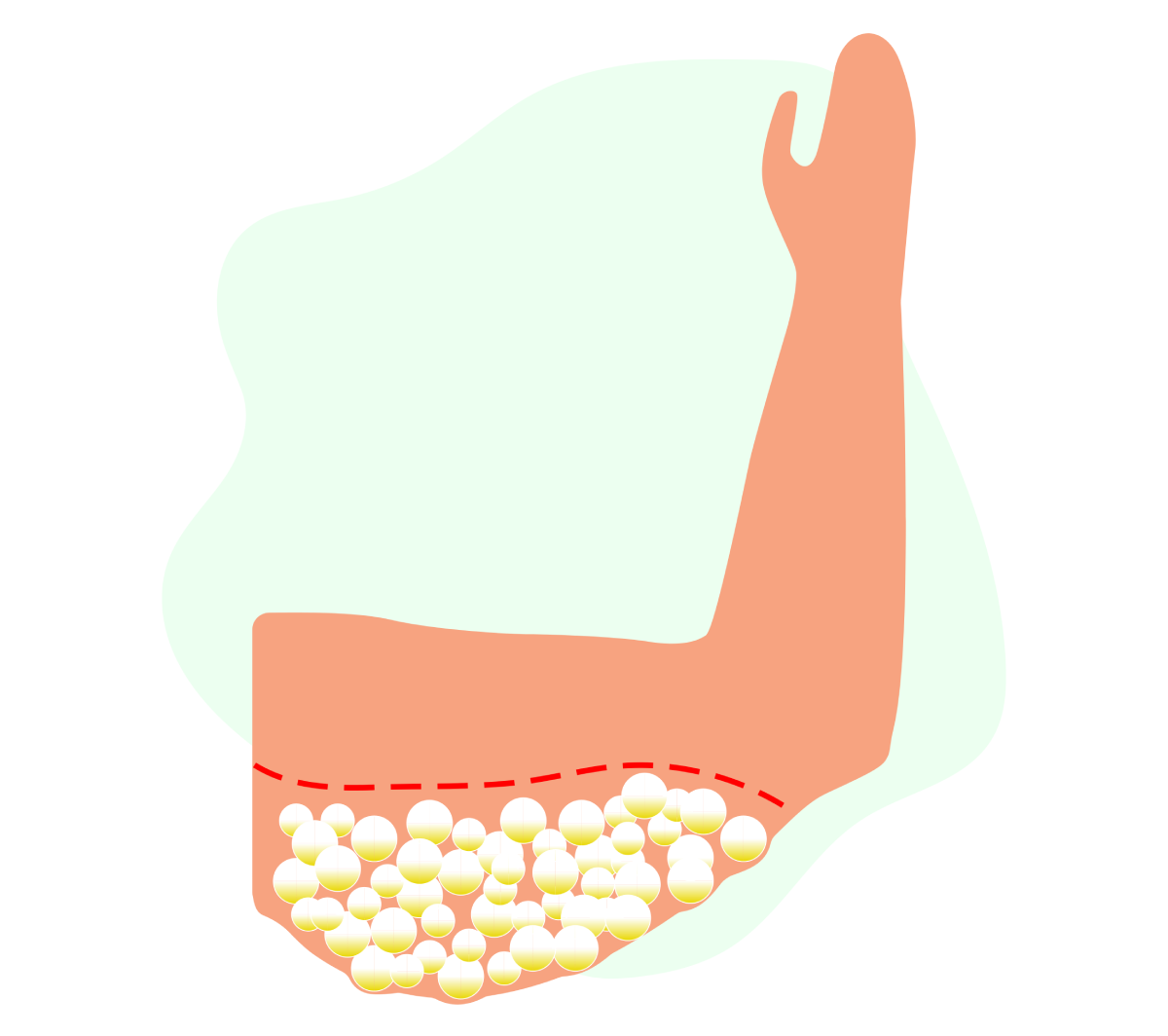 Illustration of an arm with a red dashed line near the upper arm and clusters of yellow and white circles below, representing subcutaneous fat.