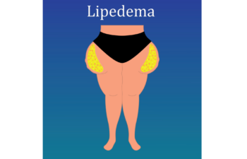 Illustration of a person with lipedema, showing excessive fat accumulation on the hips and thighs in yellow, set against a blue background.