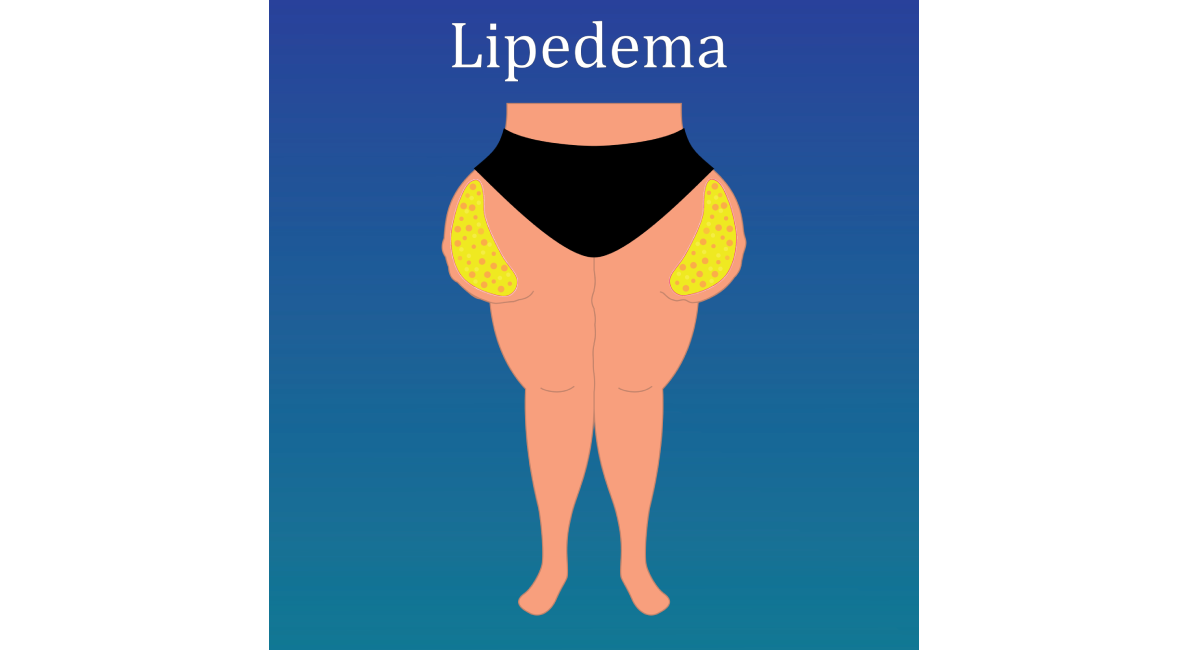 Illustration of a person with lipedema, showing excessive fat accumulation on the hips and thighs in yellow, set against a blue background.