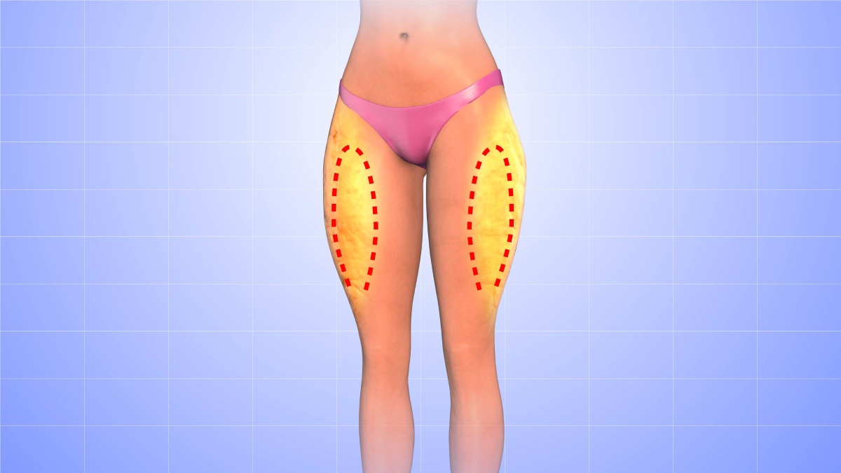 Illustration of a woman’s legs showing highlighted areas and dashed lines on the outer thighs, indicating possible locations for a medical or cosmetic procedure.